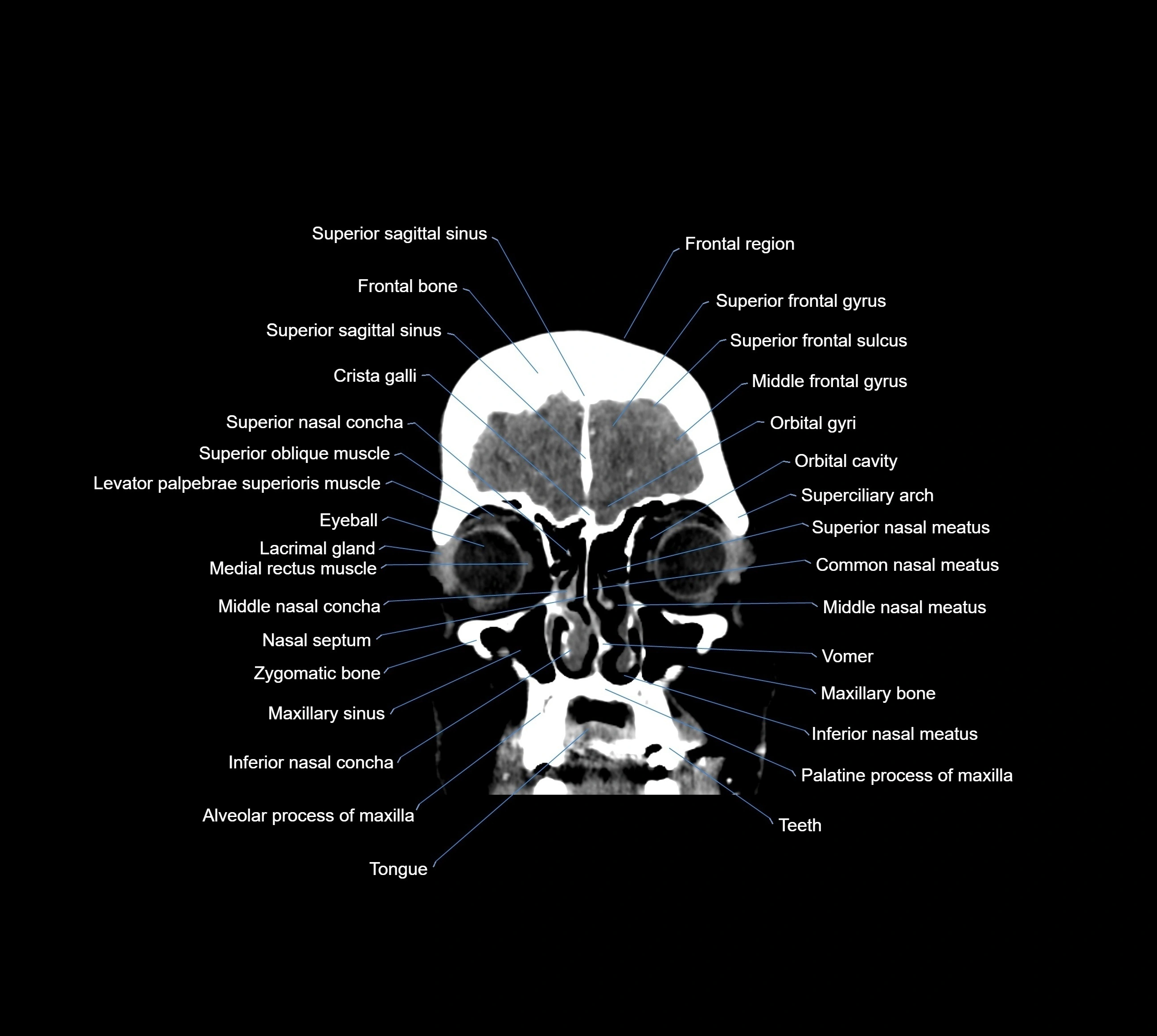 CT Brain coronal cross sectional radiology anatomy image  -img-00001-08.webp